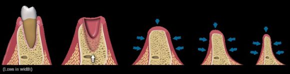 Bone loss after tooth extraction