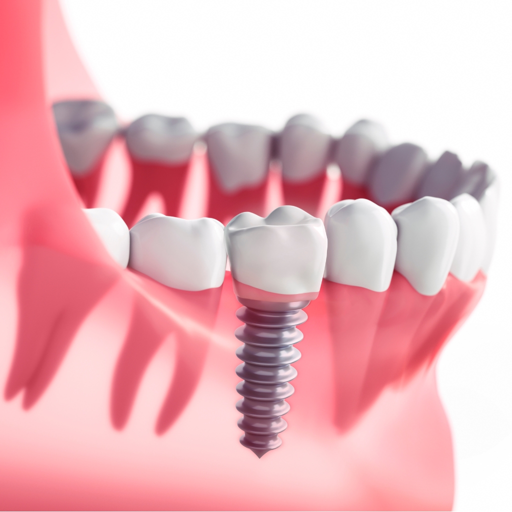 Planned dental implant