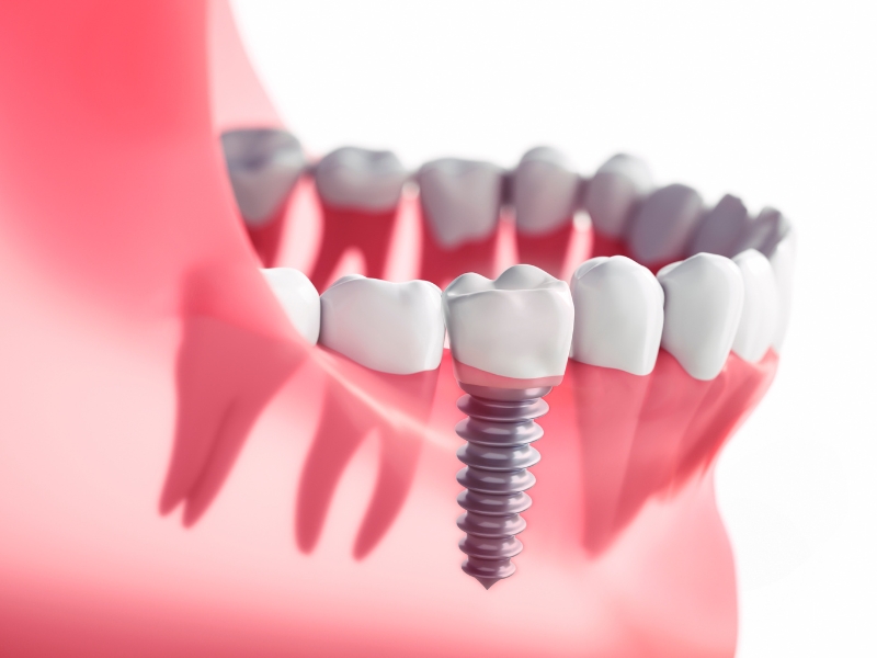 Dental implants