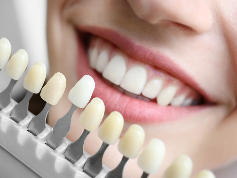 Close-up of a dazzling smile next to shade guide, showcasing options for the best teeth whitening for sensitive teeth.